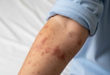 Confirma primer caso de sarampión en Puebla