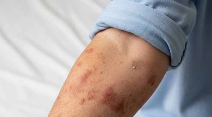 Siguen a la alza casos de Sarampión en Puebla; suman 66